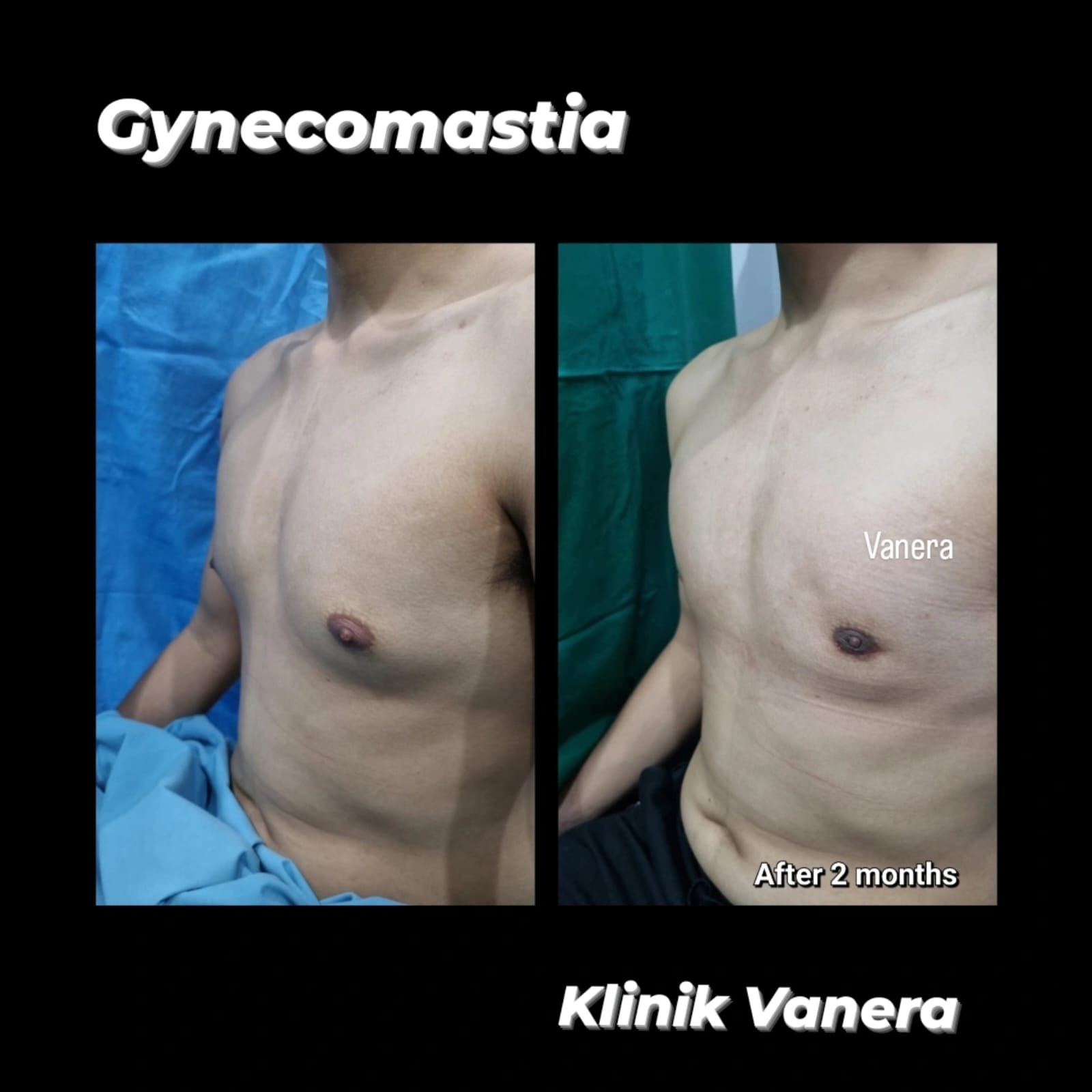 Before after gynecomastia
